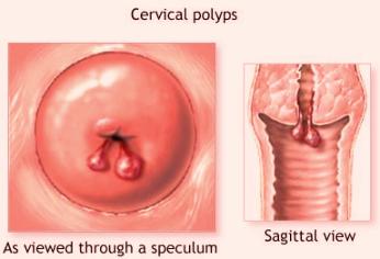 cervical polyps