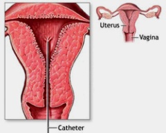 double uterus