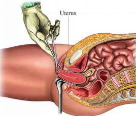 vaginal hysterectomy