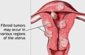 fibroid tumors