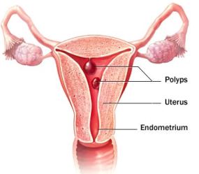uterine polyp