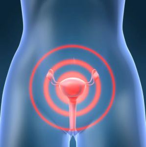 What is Ovarian Cancer