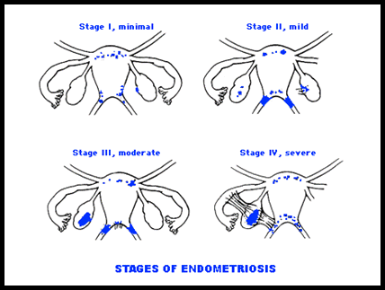 Endometriosis Stages