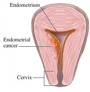 Symptoms of Endometrial Cancer