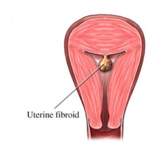 Fibroid Removal