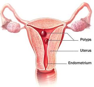 uterine-polyps-symptoms