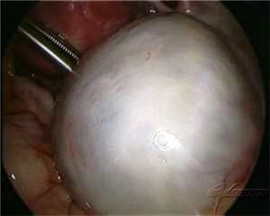 hemorrhagic-ovarian-cyst