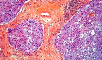 Symptoms of Invasive Ductal Carcinoma