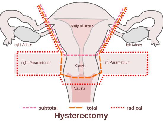 combining hysterectomy With tummy tuck