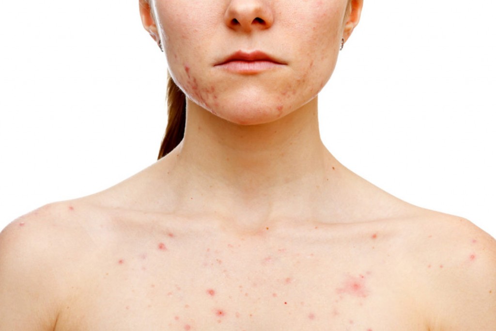 Diet Tips to Prevent Hormonal Acne