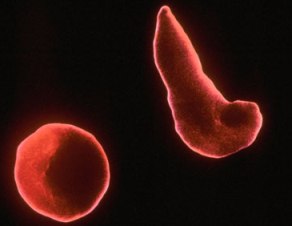 Sickle Cell Anemia