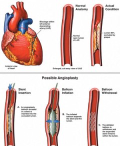 Coronary Heart Disease