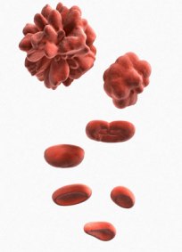 Aplastic Anemia