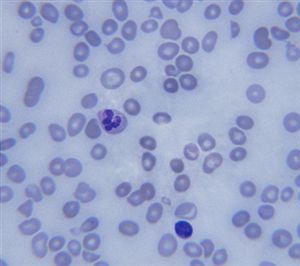 Pernicious Anemia Symptoms