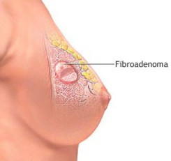 Fibroadenomas