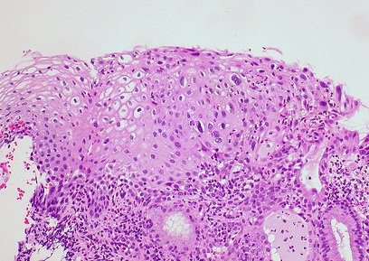Low grade squamous intraepithelial lesion