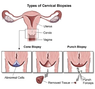 Cervical Biopsy