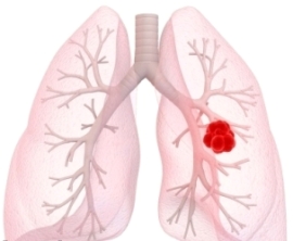Treatment for Lung Cancer in Women