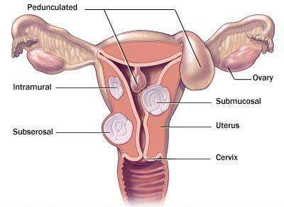 symptoms-of-fibroids